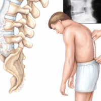 Viêm cột sống dính khớp