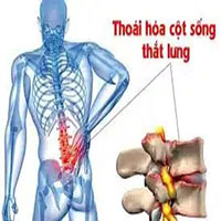 Thoái hóa cột sống
